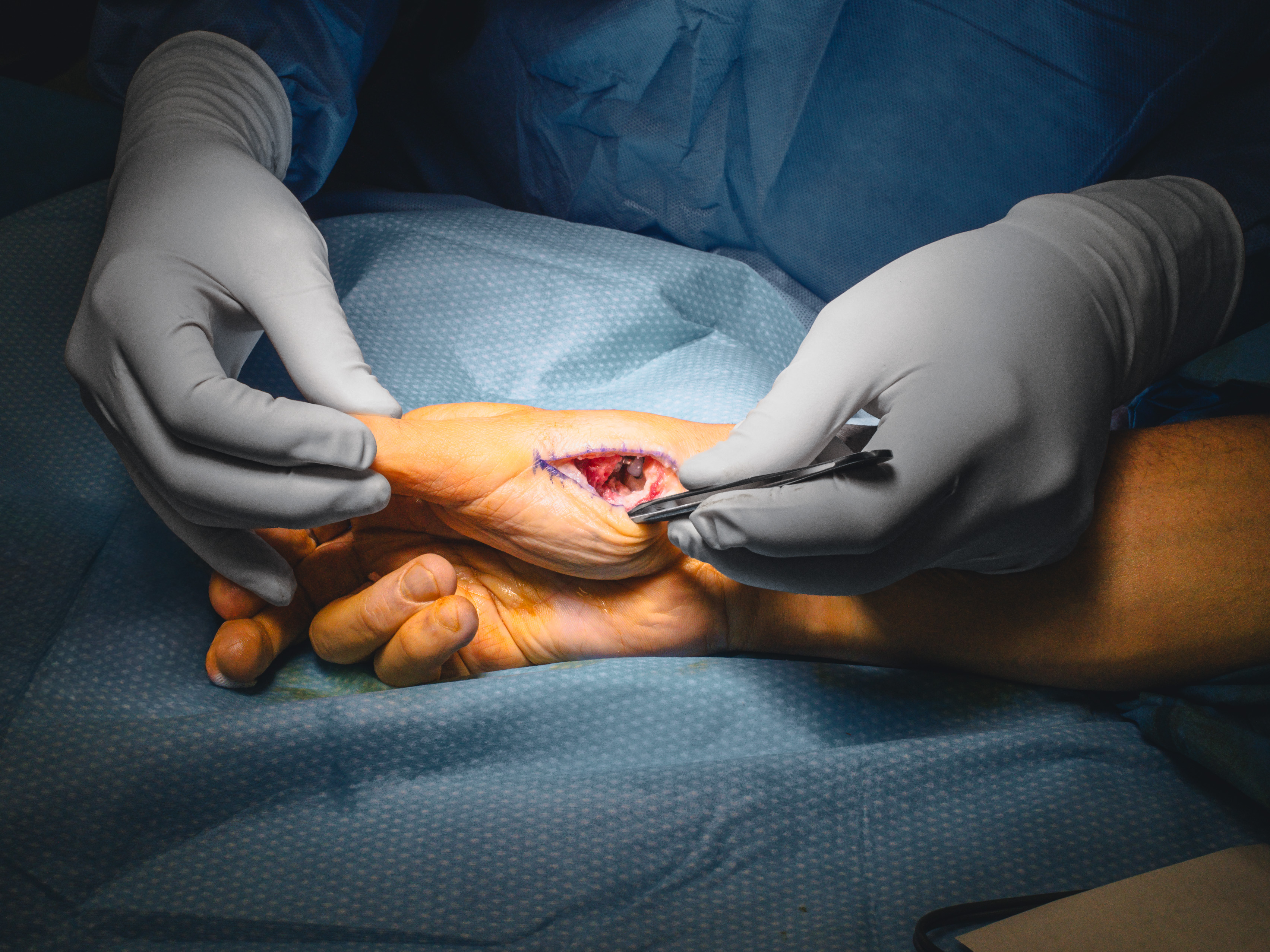 3 months in a surgery room.